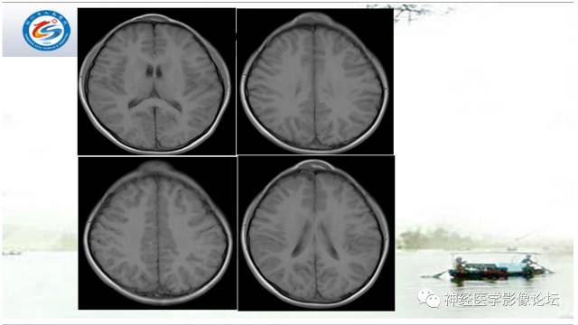 【病例】颅骨骨膜窦1例MR影像表现