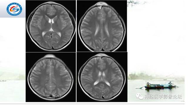 【病例】颅骨骨膜窦1例MR影像表现