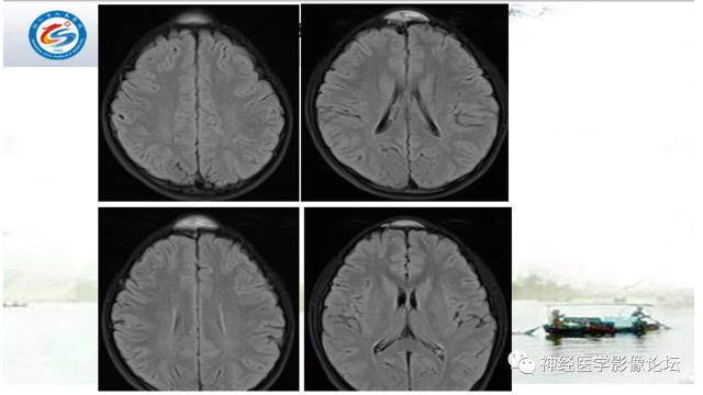 【病例】颅骨骨膜窦1例MR影像表现