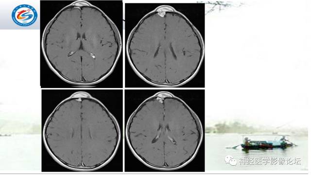 【病例】颅骨骨膜窦1例MR影像表现