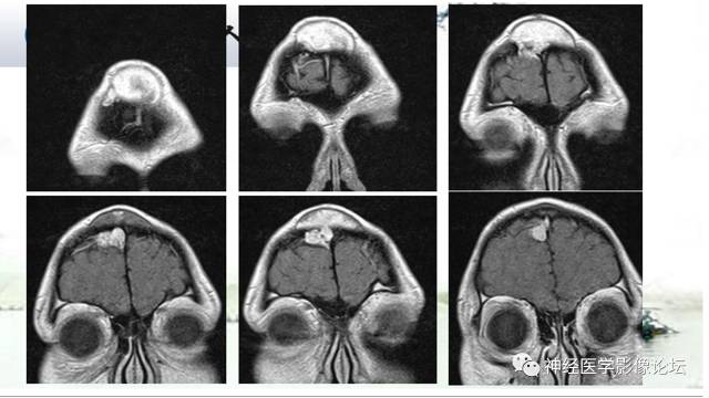 【病例】颅骨骨膜窦1例MR影像表现