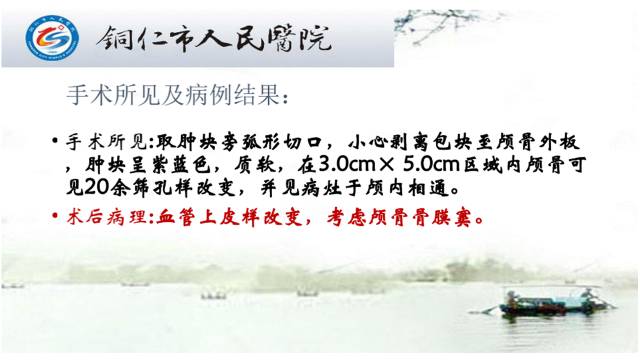 【病例】颅骨骨膜窦1例MR影像表现