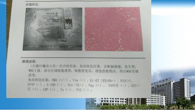 【病例】囊性脑膜瘤1例MR