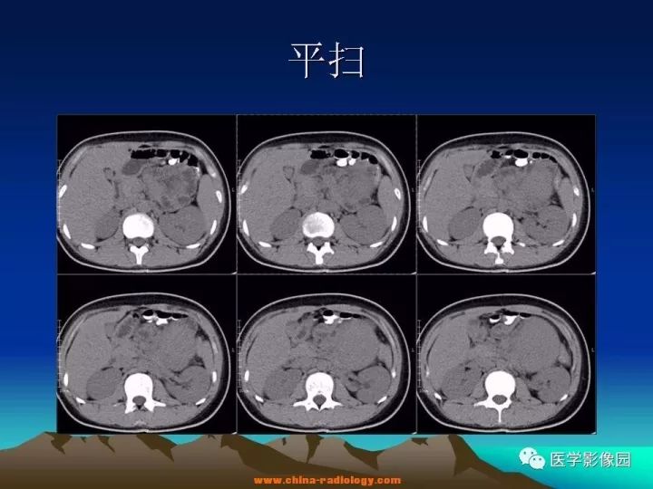 【病例】肠系膜巨淋巴结增生症1例CT影像表现 【病例】肠系膜巨淋巴结增生症1例CT影像表现