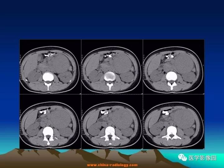 【病例】肠系膜巨淋巴结增生症1例CT影像表现 【病例】肠系膜巨淋巴结增生症1例CT影像表现