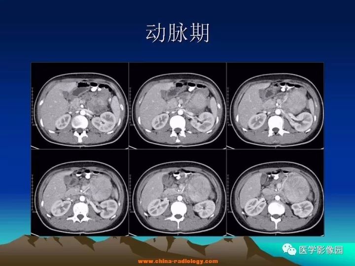 【病例】肠系膜巨淋巴结增生症1例CT影像表现 【病例】肠系膜巨淋巴结增生症1例CT影像表现