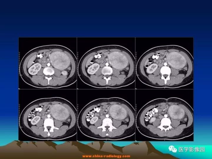 【病例】肠系膜巨淋巴结增生症1例CT影像表现 【病例】肠系膜巨淋巴结增生症1例CT影像表现