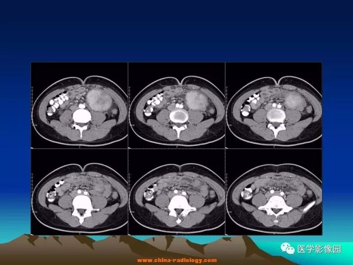 【病例】肠系膜巨淋巴结增生症1例CT影像表现 【病例】肠系膜巨淋巴结增生症1例CT影像表现