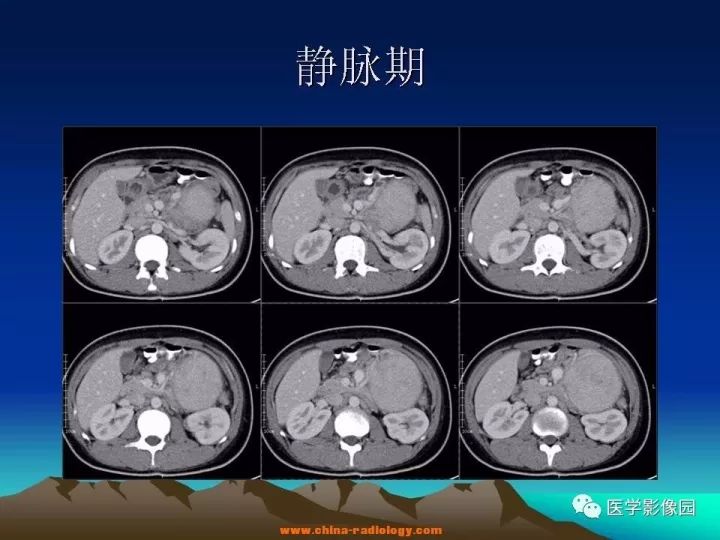 【病例】肠系膜巨淋巴结增生症1例CT影像表现 【病例】肠系膜巨淋巴结增生症1例CT影像表现