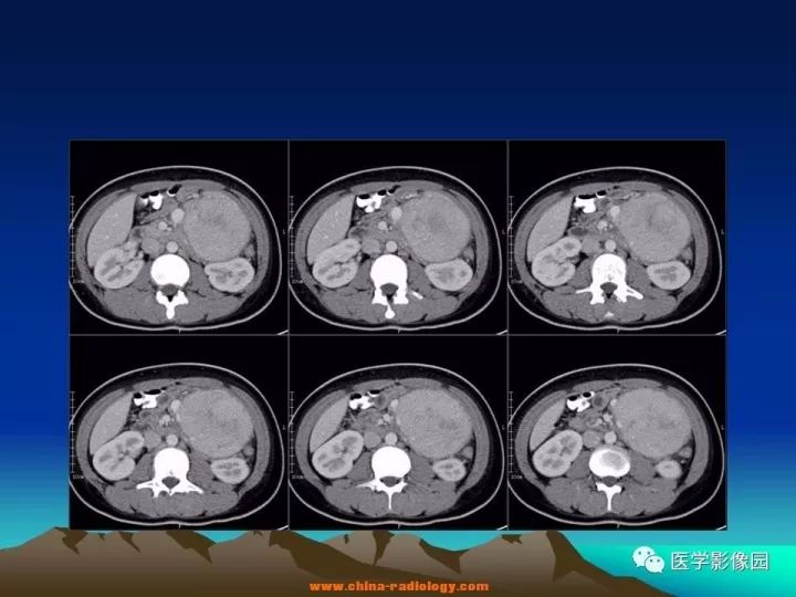 【病例】肠系膜巨淋巴结增生症1例CT影像表现 【病例】肠系膜巨淋巴结增生症1例CT影像表现