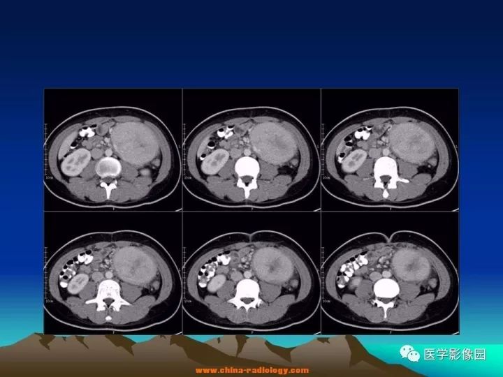 【病例】肠系膜巨淋巴结增生症1例CT影像表现 【病例】肠系膜巨淋巴结增生症1例CT影像表现