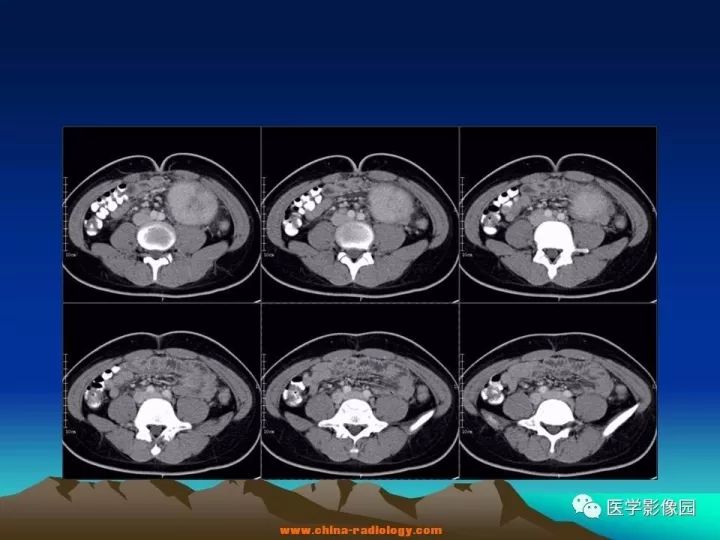 【病例】肠系膜巨淋巴结增生症1例CT影像表现 【病例】肠系膜巨淋巴结增生症1例CT影像表现