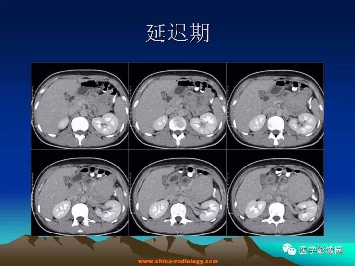 【病例】肠系膜巨淋巴结增生症1例CT影像表现 【病例】肠系膜巨淋巴结增生症1例CT影像表现
