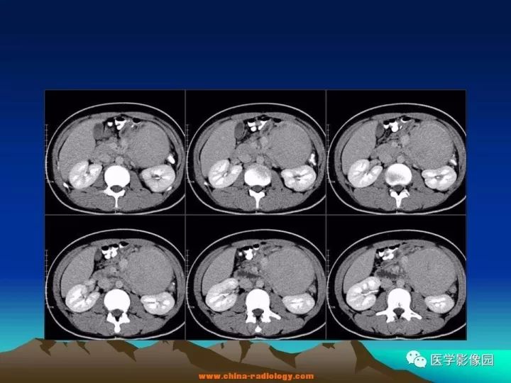 【病例】肠系膜巨淋巴结增生症1例CT影像表现 【病例】肠系膜巨淋巴结增生症1例CT影像表现