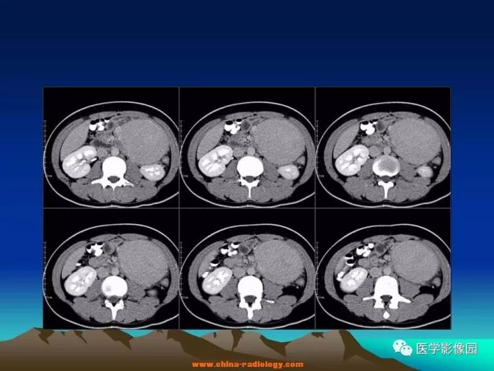 【病例】肠系膜巨淋巴结增生症1例CT影像表现 【病例】肠系膜巨淋巴结增生症1例CT影像表现