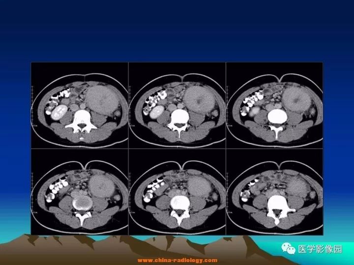 【病例】肠系膜巨淋巴结增生症1例CT影像表现 【病例】肠系膜巨淋巴结增生症1例CT影像表现