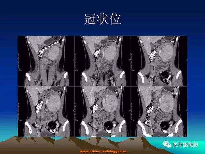 【病例】肠系膜巨淋巴结增生症1例CT影像表现 【病例】肠系膜巨淋巴结增生症1例CT影像表现
