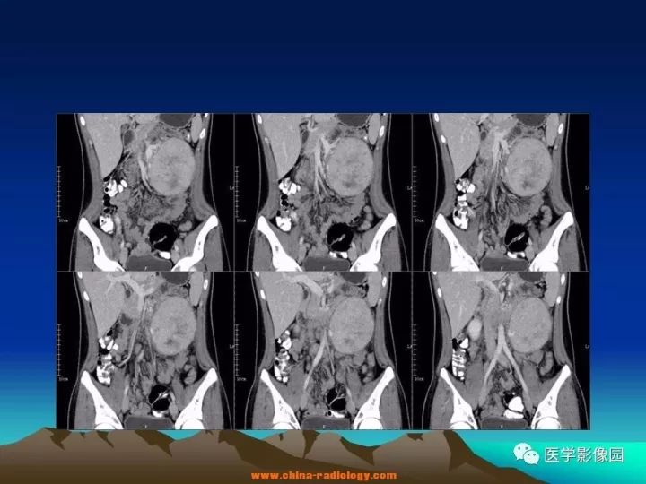 【病例】肠系膜巨淋巴结增生症1例CT影像表现 【病例】肠系膜巨淋巴结增生症1例CT影像表现