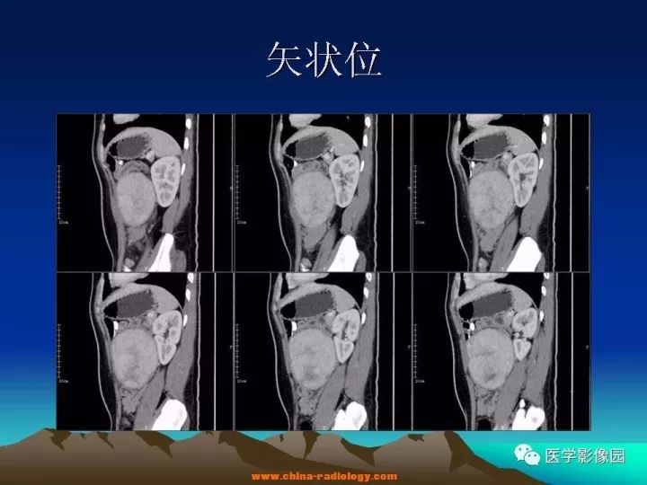 【病例】肠系膜巨淋巴结增生症1例CT影像表现 【病例】肠系膜巨淋巴结增生症1例CT影像表现