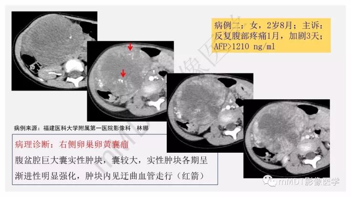 【PPT】卵黄囊瘤(内胚窦瘤)影像诊断
