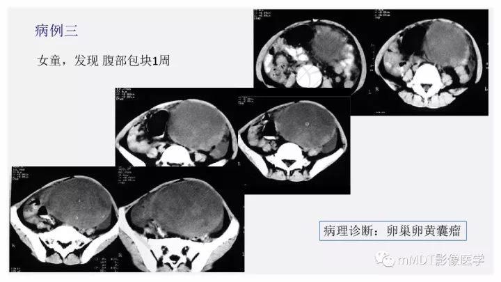 【PPT】卵黄囊瘤(内胚窦瘤)影像诊断