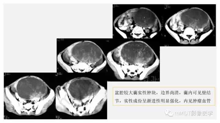 【PPT】卵黄囊瘤(内胚窦瘤)影像诊断
