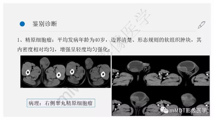 【PPT】卵黄囊瘤(内胚窦瘤)影像诊断
