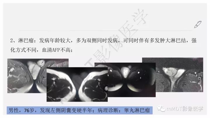 【PPT】卵黄囊瘤(内胚窦瘤)影像诊断