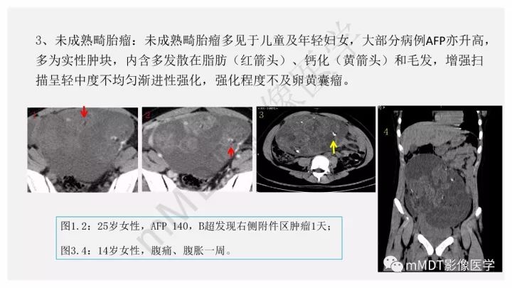 【PPT】卵黄囊瘤(内胚窦瘤)影像诊断