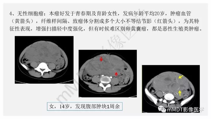 【PPT】卵黄囊瘤(内胚窦瘤)影像诊断