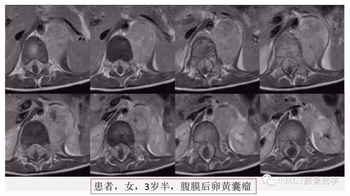 【PPT】卵黄囊瘤(内胚窦瘤)影像诊断