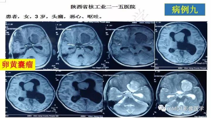 【PPT】卵黄囊瘤(内胚窦瘤)影像诊断