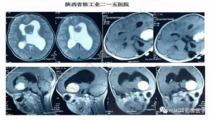 【PPT】卵黄囊瘤(内胚窦瘤)影像诊断