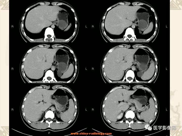 【病例】深在性囊性胃炎1例CT影像表现 【病例】深在性囊性胃炎1例CT影像表现