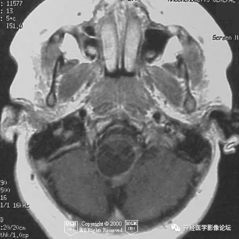 【病例】颈髓神经节细胞胶质瘤1例MR影像表现 【病例】颈髓神经节细胞胶质瘤1例MR影像表现