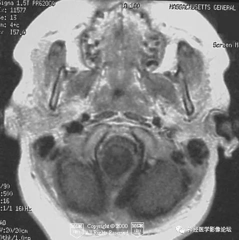 【病例】颈髓神经节细胞胶质瘤1例MR影像表现 【病例】颈髓神经节细胞胶质瘤1例MR影像表现