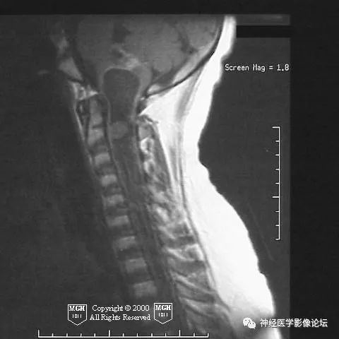 【病例】颈髓神经节细胞胶质瘤1例MR影像表现 【病例】颈髓神经节细胞胶质瘤1例MR影像表现