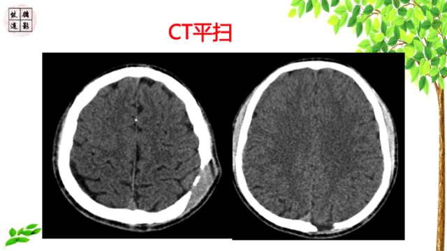 【病例】颅骨嗜酸性肉芽肿1例CT及MR影像诊断