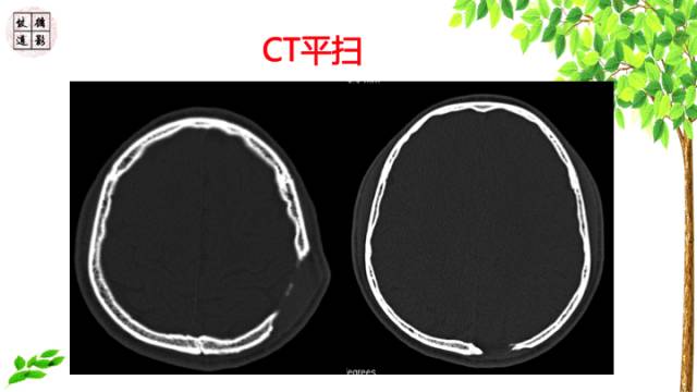 【病例】颅骨嗜酸性肉芽肿1例CT及MR影像诊断
