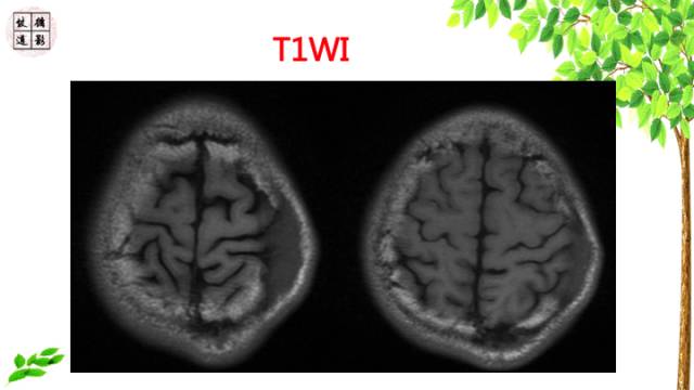 【病例】颅骨嗜酸性肉芽肿1例CT及MR影像诊断