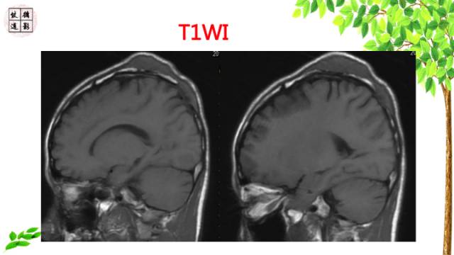 【病例】颅骨嗜酸性肉芽肿1例CT及MR影像诊断