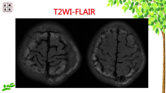 【病例】颅骨嗜酸性肉芽肿1例CT及MR影像诊断