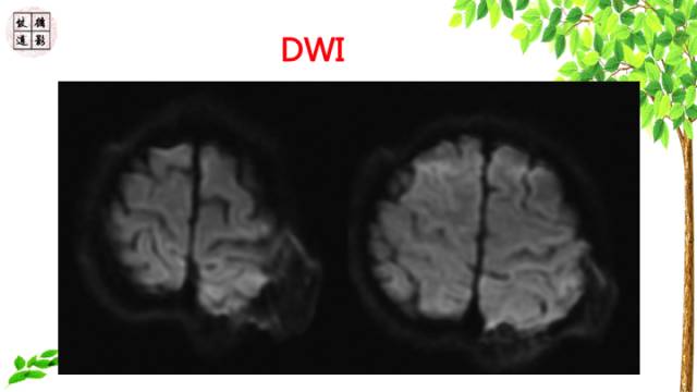 【病例】颅骨嗜酸性肉芽肿1例CT及MR影像诊断