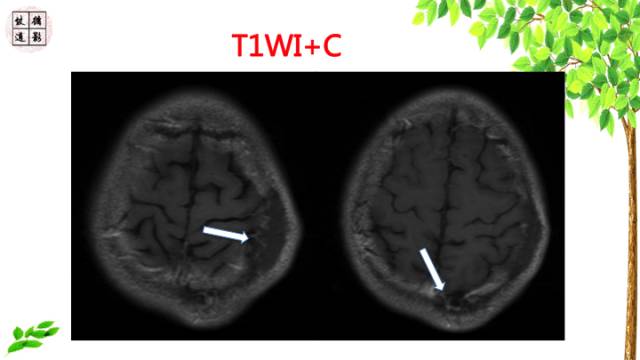 【病例】颅骨嗜酸性肉芽肿1例CT及MR影像诊断