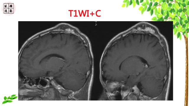 【病例】颅骨嗜酸性肉芽肿1例CT及MR影像诊断