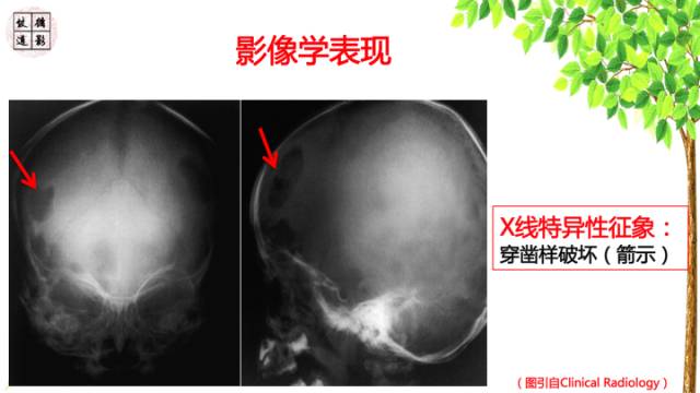 【病例】颅骨嗜酸性肉芽肿1例CT及MR影像诊断