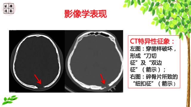 【病例】颅骨嗜酸性肉芽肿1例CT及MR影像诊断