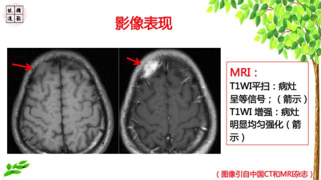 【病例】颅骨嗜酸性肉芽肿1例CT及MR影像诊断