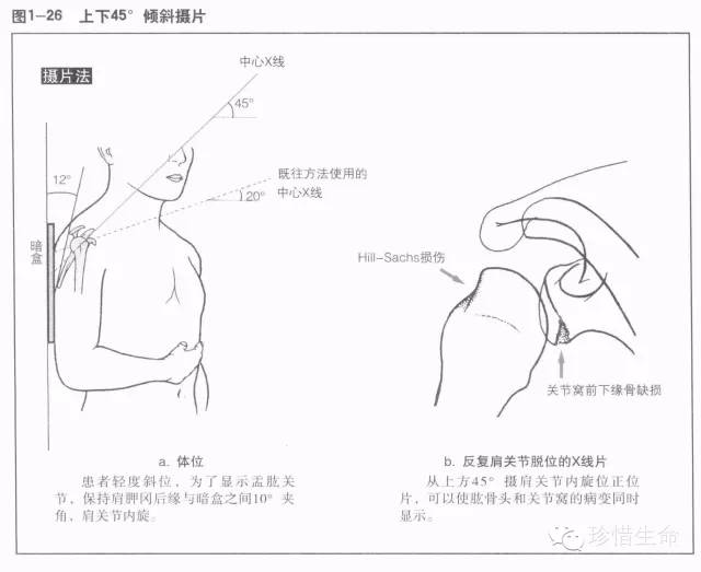 详细的肩关节X线解剖+发育+摄影技巧+测量方法 详细的肩关节X线解剖+发育+摄影技巧+测量方法