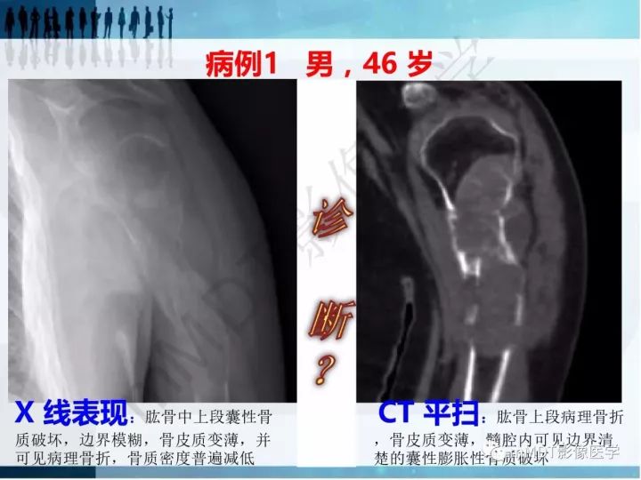 【PPT】纤维囊性骨炎的影像诊断